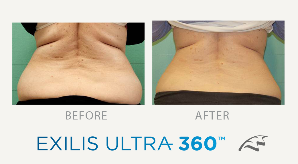 exilis ultra 360 before & After back fat