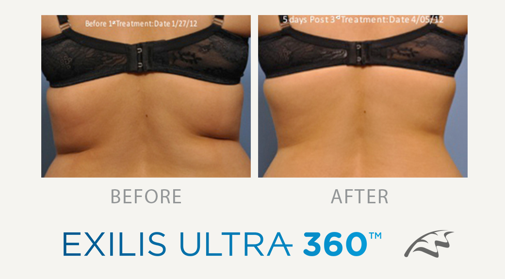 Exilis Ultra 360 Before After back fat