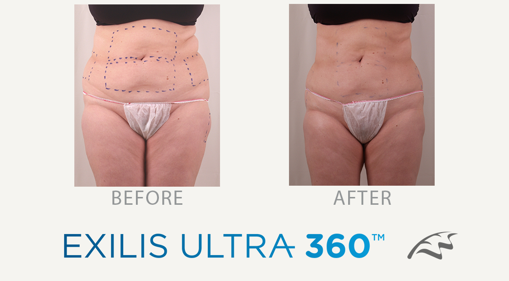 Exilis ultra 360 Before & After Wimbledon tummy belly