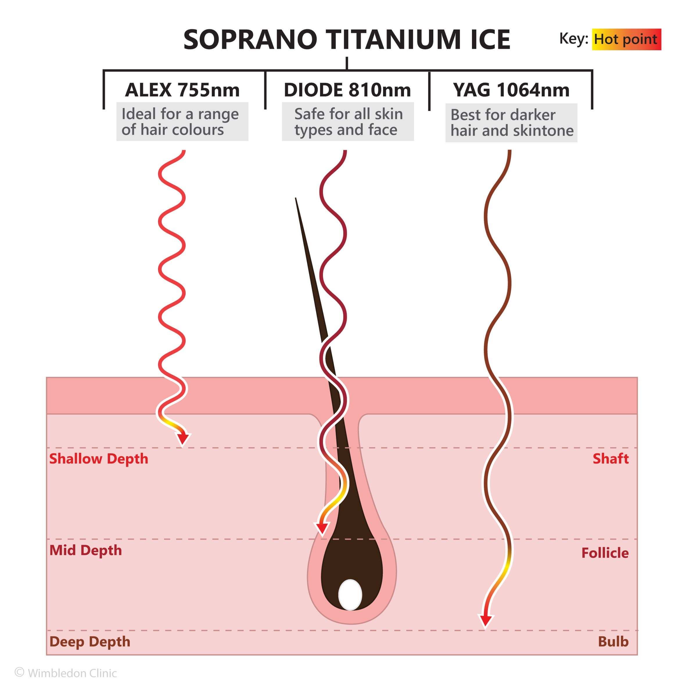 Hair removal soprano titanium ice wavelength alex diode ng yag depths