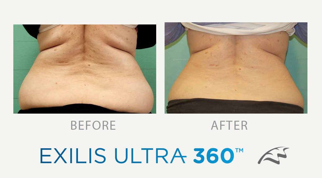 back fat treatment exilis ultra 360 treatment wimbledon