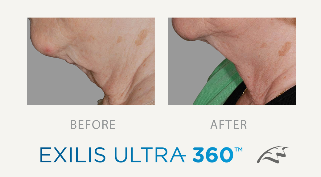 Exilis_ultra_treatment_before-after-jowels_wimbledon_london