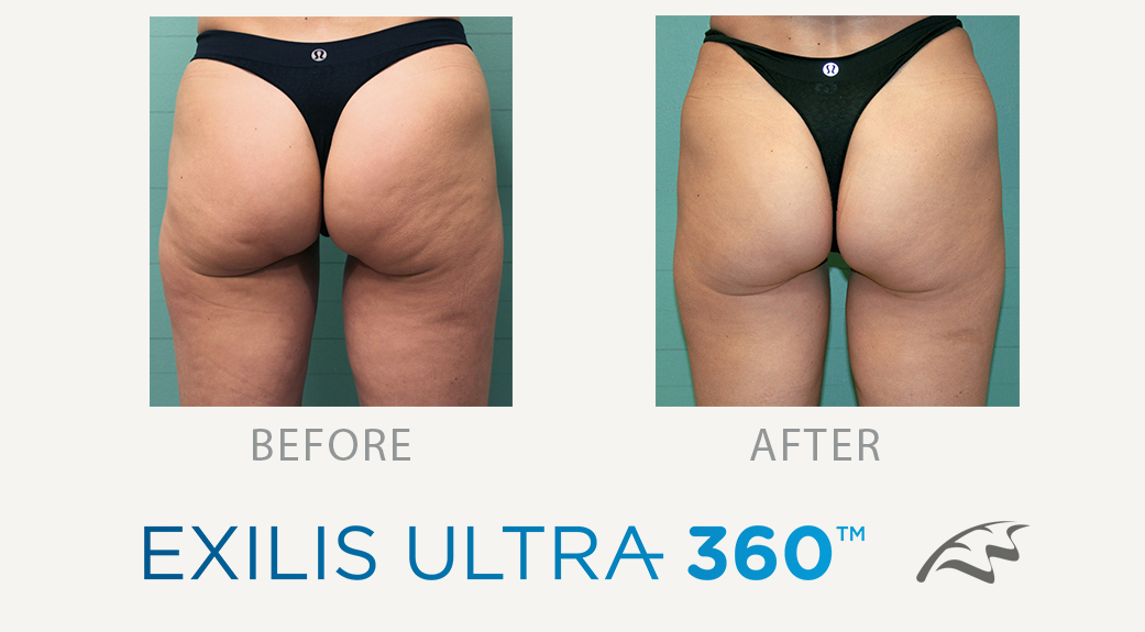 before and after thighs cellulite teratment wimbledon exilis ultra