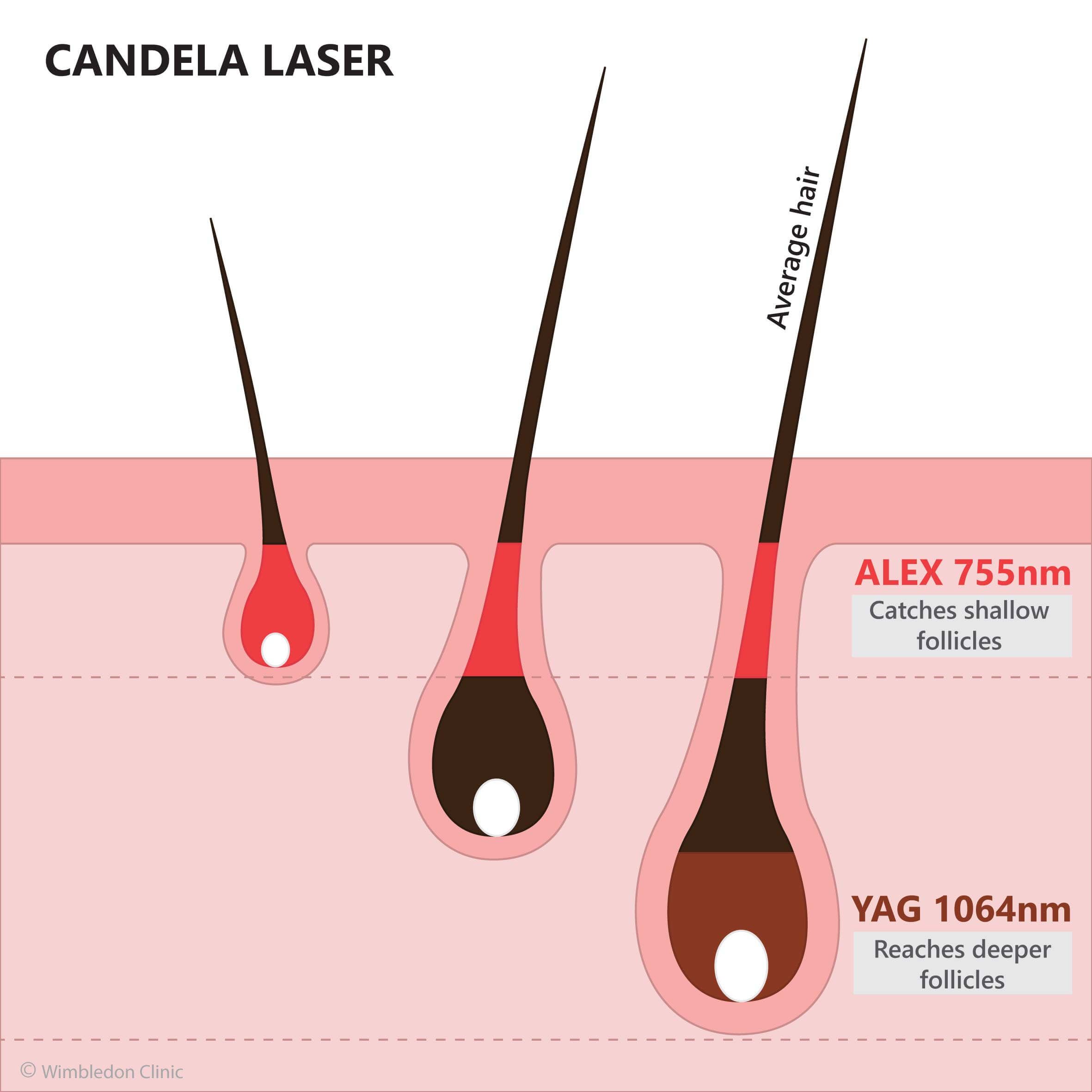 candela removal shallow deep follicle missed area