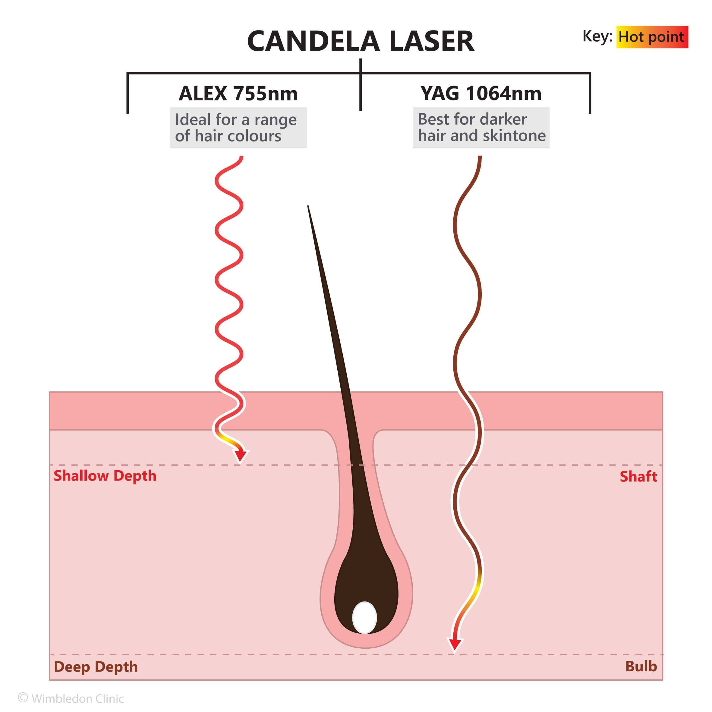 candela hair follicle hot point laser reduction light