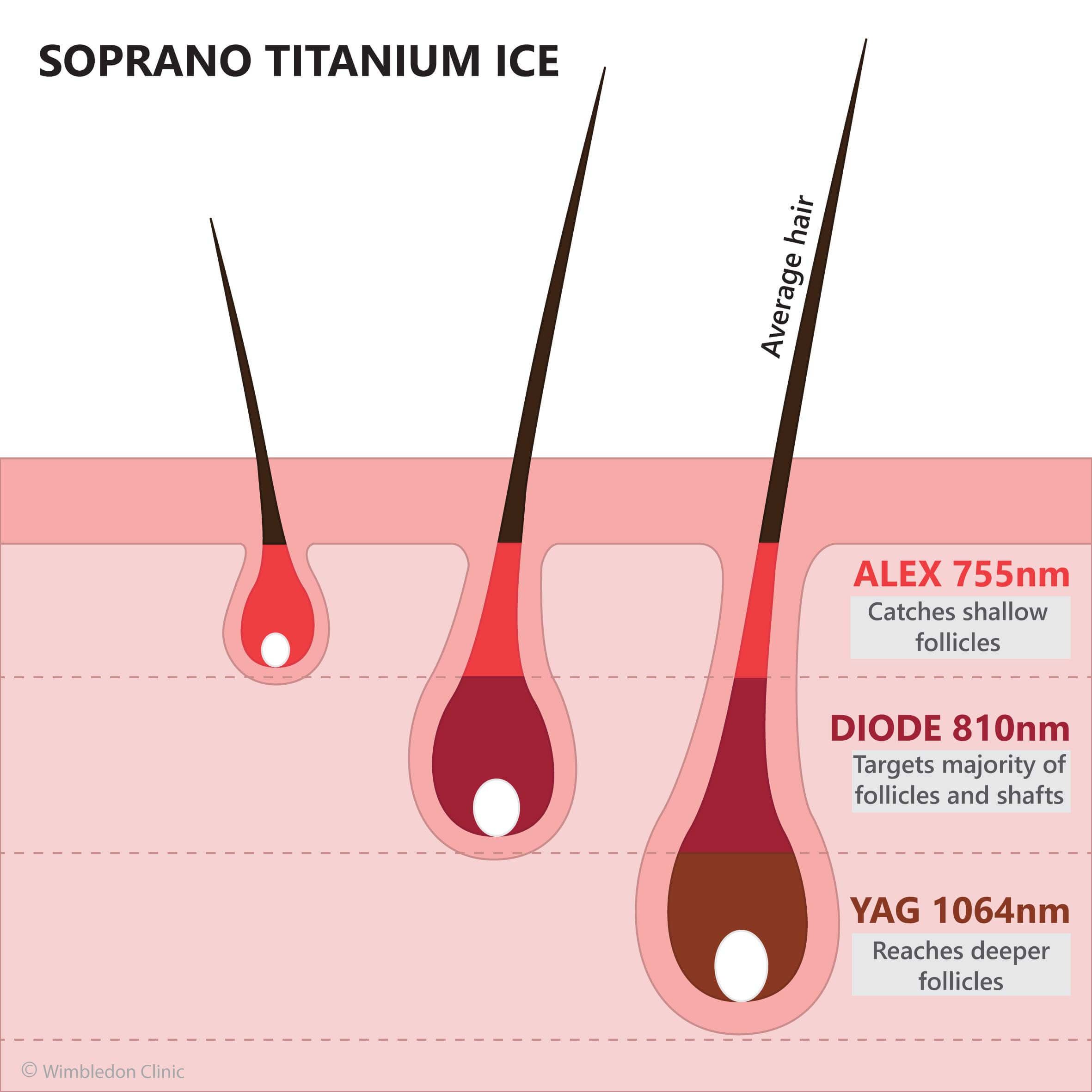 Laser works Alma hair depth treatment follicle shaft soprano infographic