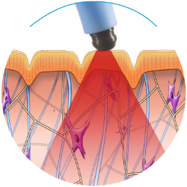 how the exilis ultra treatment stimulates the skin at the wimbledon clinic aesthetics department London