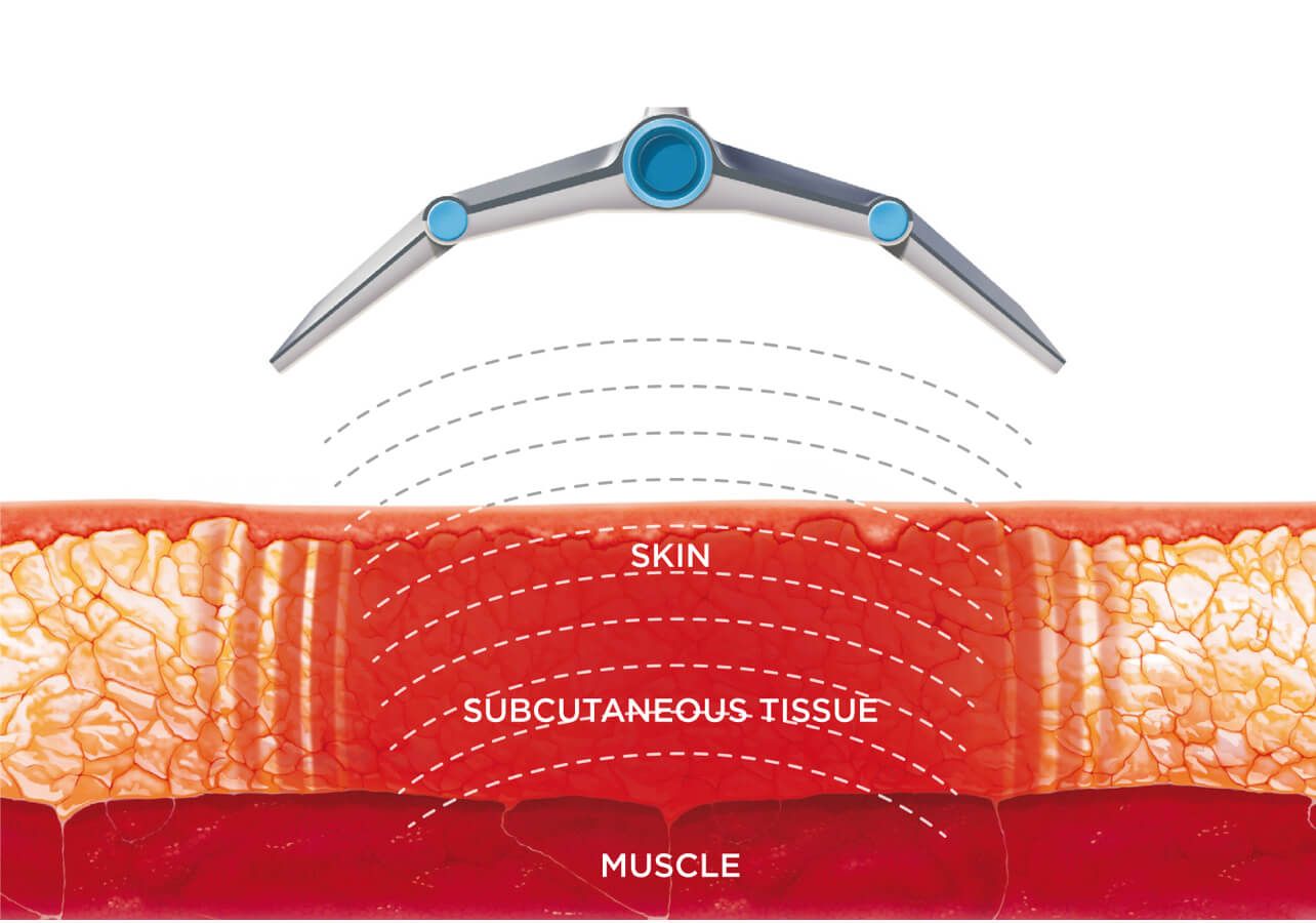 candela removal shallow deep follicle missed area