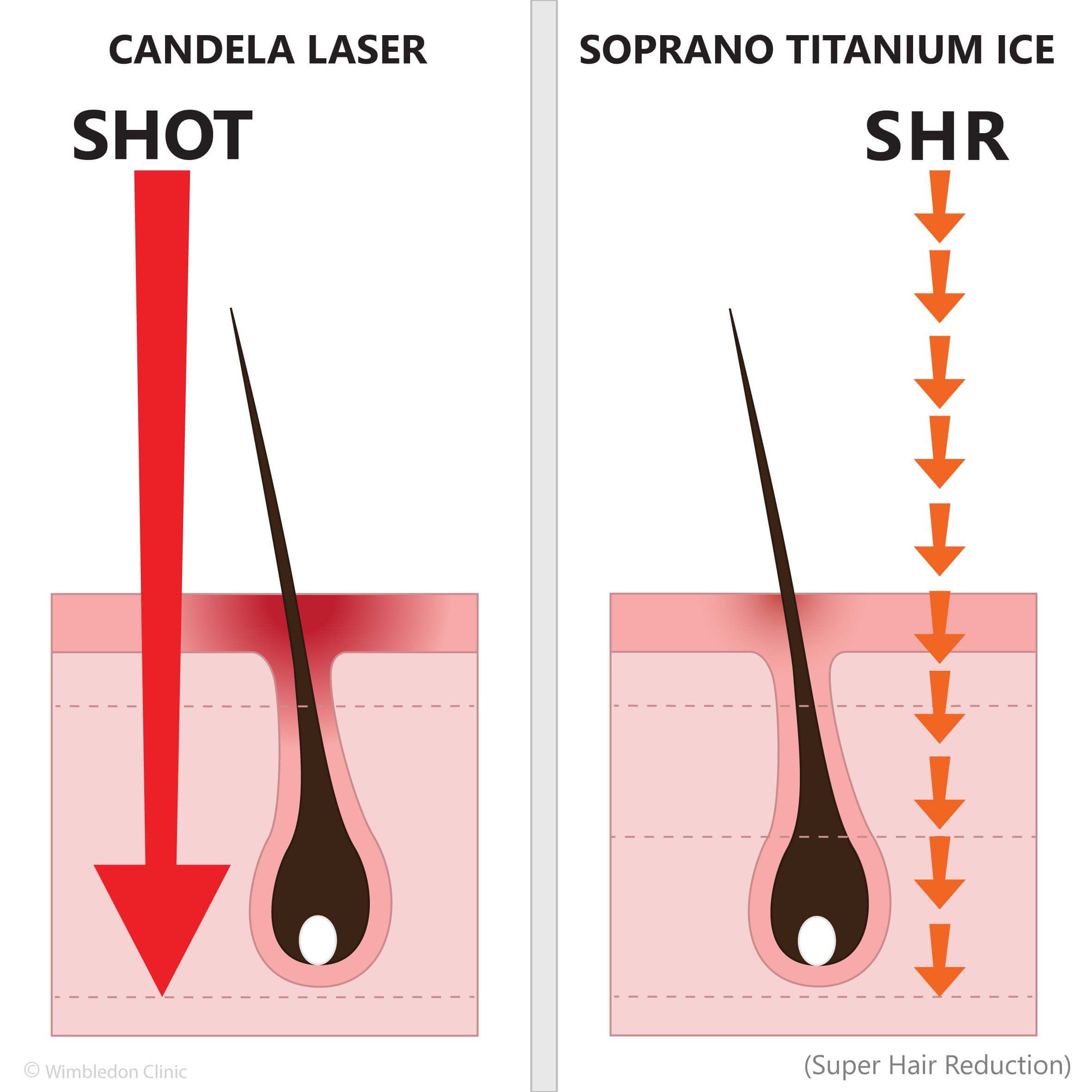 candela soprano titanium shot super hair reduction shr pulse laser burns