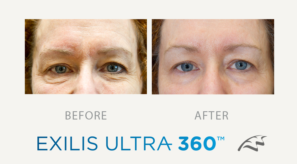 Exilis_before__after_face_eyes_wimbledon_clinic_aesthetics