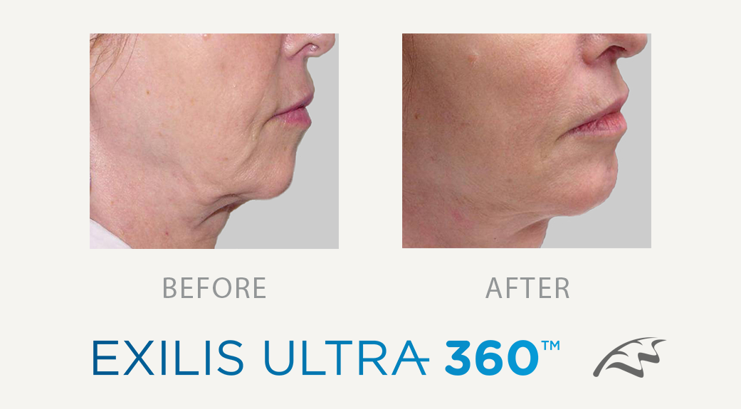 exilis_ultra_360_before_after_wimbledon_london