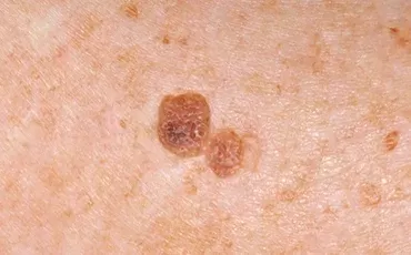 seborrheic-keratosis-sun-sport-liver-spot-treatment-wimbledon