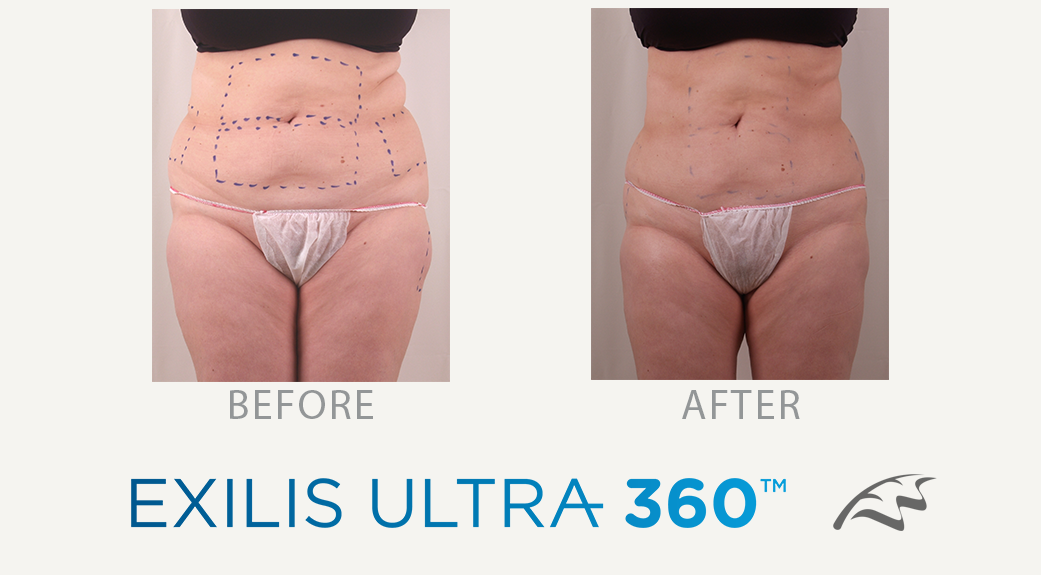 Tummy tuck without surgery teratment wimbledon exilis ultra